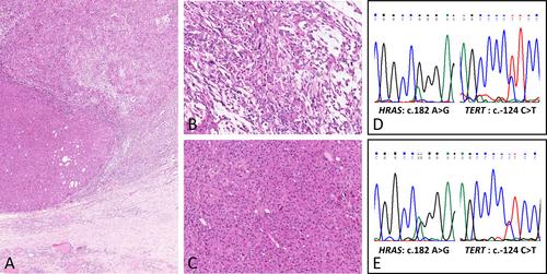 Anaplastic and poorly differentiated thyroid carcinomas: genetic evidence of high-grade transformation from differentiated thyroid carcinoma