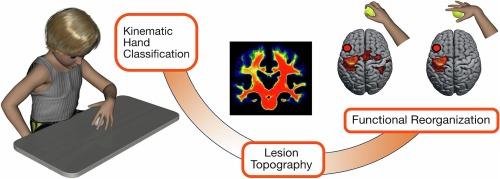 Lesion mapping and functional characterization of hemiplegic children with different patterns of hand manipulation