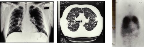 Accelerated silicosis in sandblasters: Pathology, mineralogy, and clinical correlates