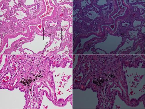 Interstitial pulmonary disease and aluminum trihydrate exposure: A single case report and detailed workplace analysis