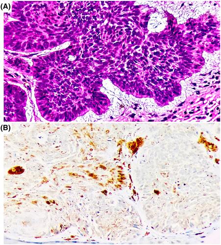 PTCH1 gene variants rs357564, rs2236405, rs2297086 and rs41313327, mRNA and tissue expression in basal cell carcinoma patients from Western Mexico