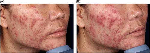 Long-term efficacy and safety of nonablative monopolar radiofrequency in the treatment of moderate to severe acne vulgaris