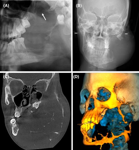 Clinicoradiologic features of ameloblastomas: A single-centre study of 155 cases