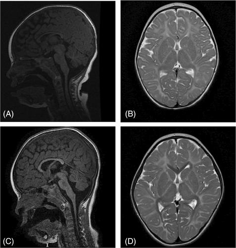 5,10-methenyltetrahydrofolate synthetase deficiency: An extreme rare defect of folate metabolism in two Dutch siblings