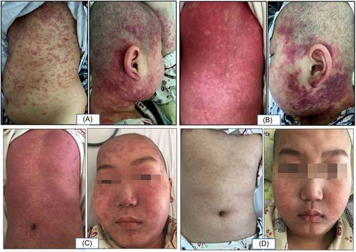 Clinical characteristics of delayed generalized erythema associated with cytarabine