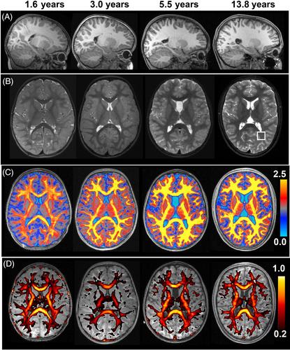 Folate receptor α deficiency – Myelin-sensitive MRI as a reliable biomarker to monitor the efficacy and long-term outcome of a new therapeutic approach