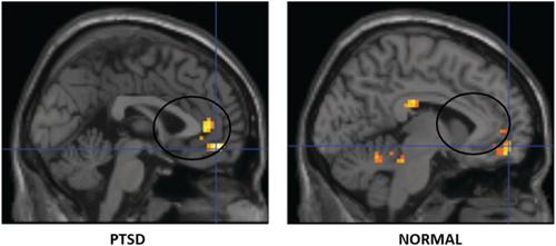 Neuroanatomical and functional correlates in post-traumatic stress disorder: A narrative review