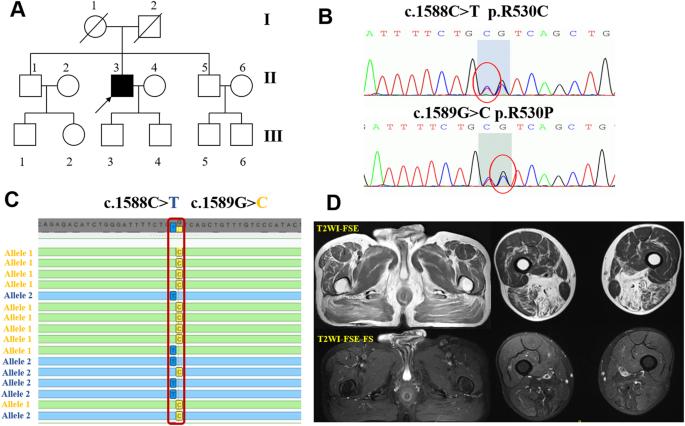 A comparative study on riboflavin responsive multiple acyl-CoA dehydrogenation deficiency due to variants in FLAD1 and ETFDH gene