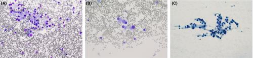 Cutaneous balloon-cell melanoma metastases to the axillary lymph node: Exploring cytomorphologic features and differential diagnoses on fine needle aspiration biopsy