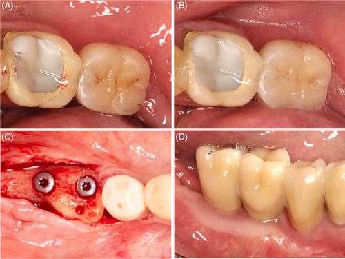 Clinical outcomes following a combined vertical and horizontal alveolar ridge augmentation and two-stage implant placement using either autogenous tooth roots or autogenous bone blocks