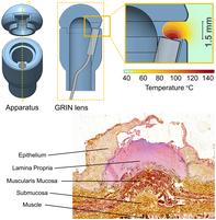 An endoscopic approach providing near-infrared laser-induced coagulation with accurate depth limits