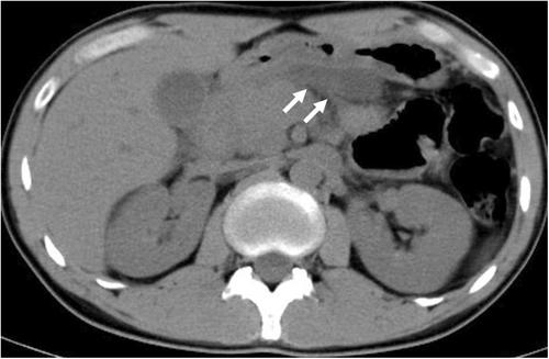 Endoscopic ultrasound-guided biopsy using a three-prong asymmetry tip needle for pancreatic tumors and peridigestive tract lesions: Retrospective single-center study