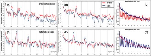 Retinal vascular dynamics: A window for observing an irregular heartbeat. A case report