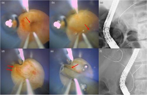 Successful cholangioscopy-guided cannulation using a novel slim cholangioscope