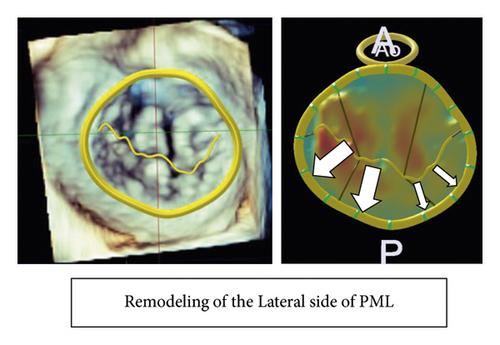 Remodeling on Lateral Side of Posterior Mitral Leaflet in Recurrent Mitral Regurgitation after Mitral Annuloplasty for Patients with Atrial Functional Mitral Regurgitation