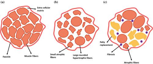 Duchenne and Becker muscular dystrophy: Cellular mechanisms, image analysis, and computational models: A review