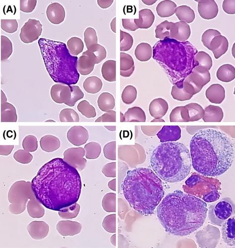 Acute myeloid leukemia with misleading cytology