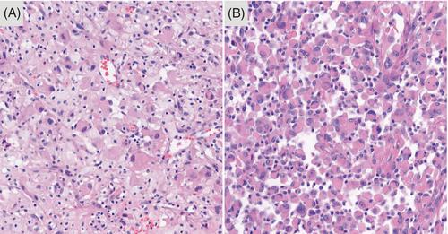 Diagnostic utility of genetic alterations in distinguishing IDH-wildtype glioblastoma from lower-grade gliomas: Insight from next-generation sequencing analysis of 479 cases