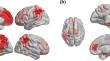 Association of a DASH diet and magnetoencephalography in dementia-free adults with different risk levels of Alzheimer's disease.