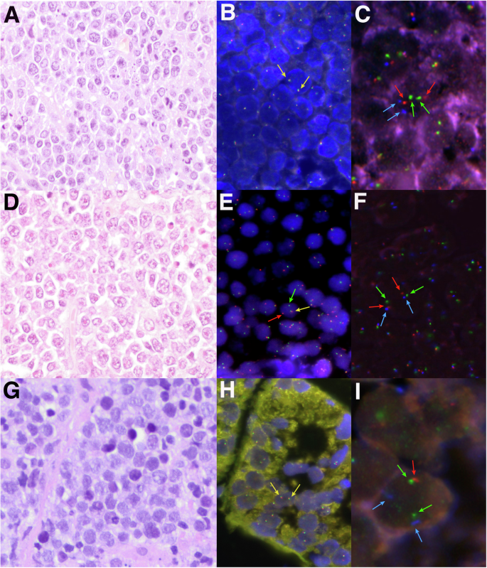 MYC-rearranged mature B-cell lymphomas in children and young adults are molecularly Burkitt Lymphoma