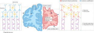 Consequences of trisomy 21 for brain development in Down syndrome