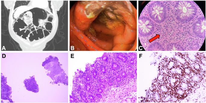 Immune effector cell-associated enterocolitis following chimeric antigen receptor T-cell therapy in multiple myeloma