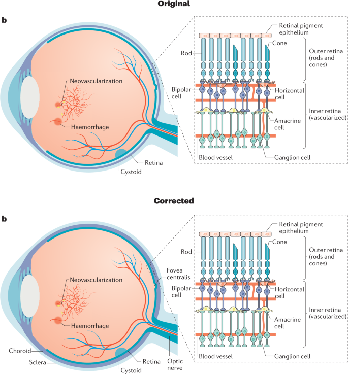 Publisher Correction: Current understanding of the molecular and cellular pathology of diabetic retinopathy