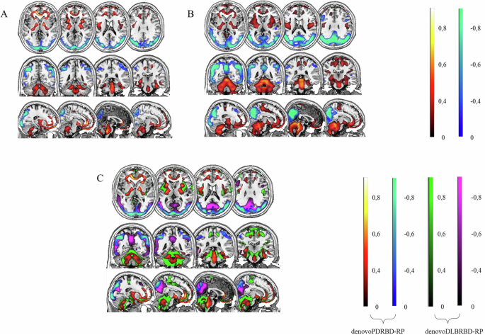 Progression trajectories from prodromal to overt synucleinopathies: a longitudinal, multicentric brain [18F]FDG-PET study