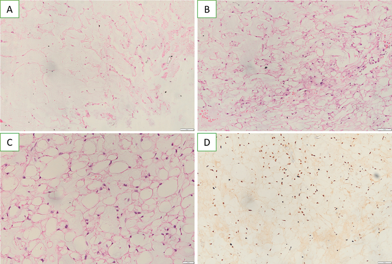 Nonenhancing Prepontine Chordoma with Diffusion Restriction Mimicking an Epidermoid Cyst.