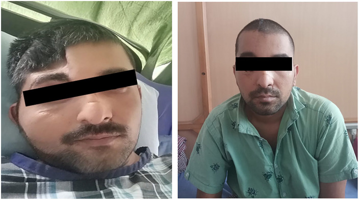Cranial Defect Repair With 3D Designed Models.