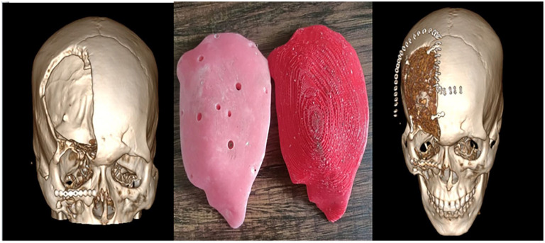 Cranial Defect Repair With 3D Designed Models.