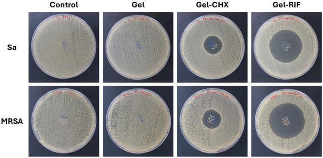 Potentiality of Antibacterial Gels for the Prophylactic Coating of Hernia Repair Prosthetic Materials.