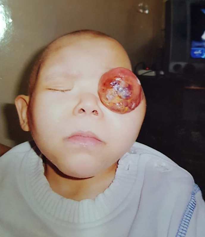 An Unexpected Response of Orbital Retinoblastoma to Inconsistent Systemic Chemotherapy Alone.