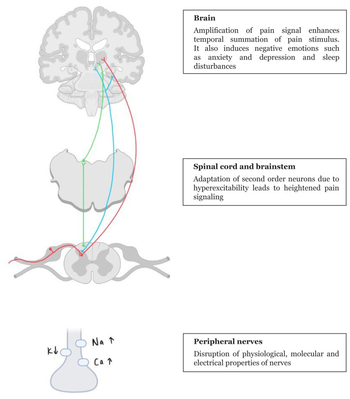 Lhermitte's Sign--A Neuropathic Pain and Its Neuroanatomy.