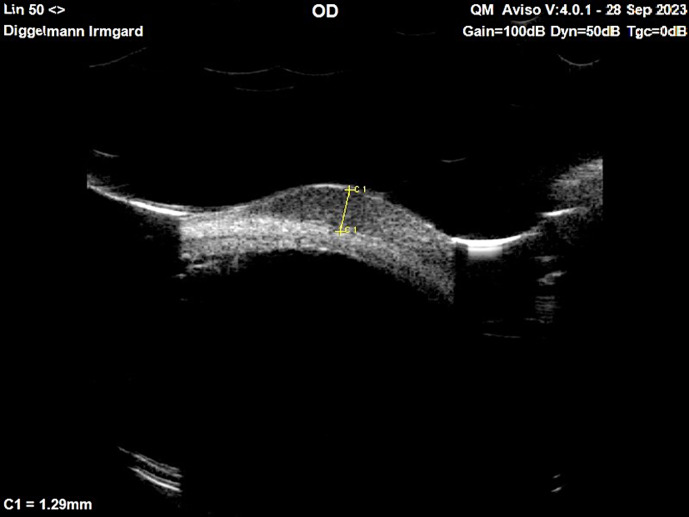 A Case of Conjunctival Melanoma Presenting as a Squamous Cell Carcinoma.