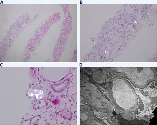 Diet-induced hyperoxaluria: A case based mini-review.