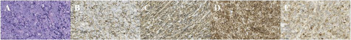 Case report: Orbital myeloid sarcoma: a report of two rare cases and review of the literature.