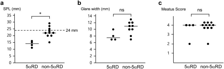 Characteristic external genitalia in male neonates with 5α-reductase deficiency.