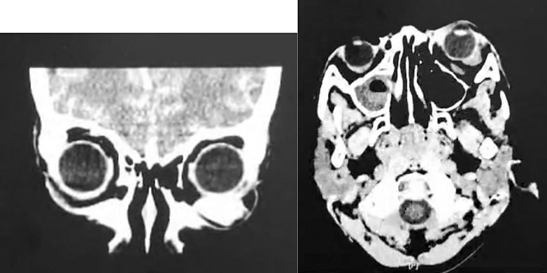 Wide-Excision Choice in Orbital Rhabdomyosarcoma on an 8-Year-Old Patient in a Low-Resource Setting: A Case Report.