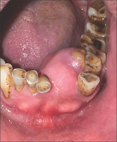 Osteochondroma of the anterior mandible: A rare case report and review of the literature.