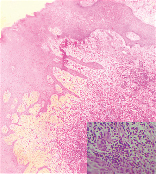 Unveiling the enigma: Navigating extranodal Rosai-Dorfman disease in the maxilla - A teen's journey.