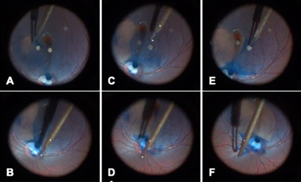 Multilayered Inverted Internal Limiting Membrane Flap Technique in Optic Disc Pit Maculopathy.