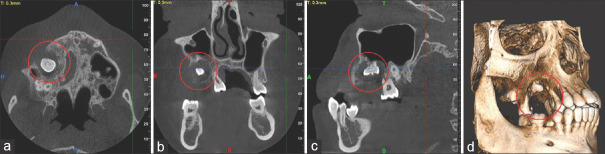 Unveiling the enigma: Navigating extranodal Rosai-Dorfman disease in the maxilla - A teen's journey.