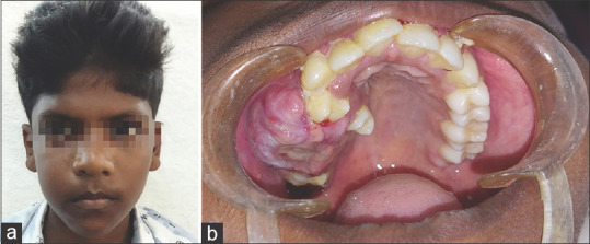 Unveiling the enigma: Navigating extranodal Rosai-Dorfman disease in the maxilla - A teen's journey.
