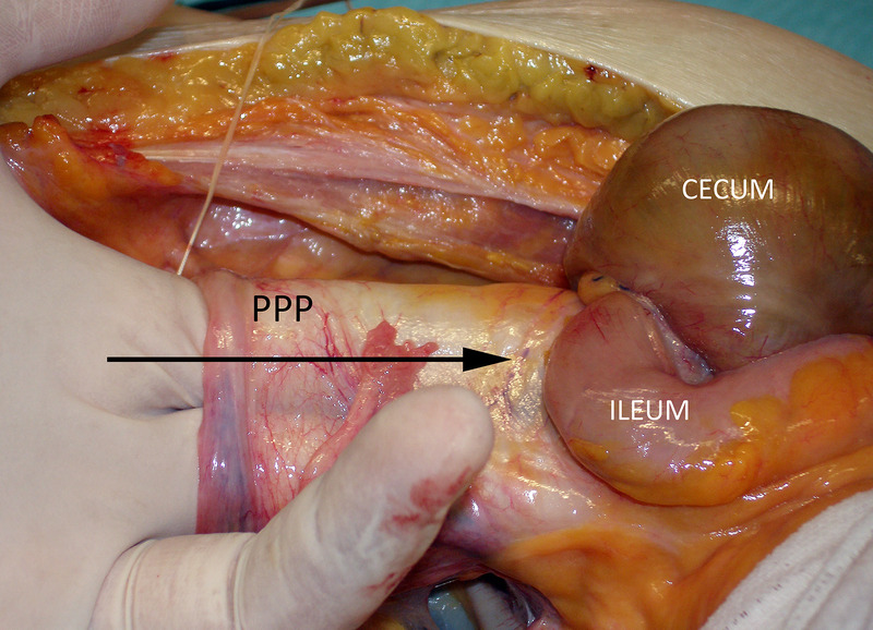 Extrauterine Causes of Severe and Concealed Postpartum Bleeding: Clinical Aspects and Challenges.