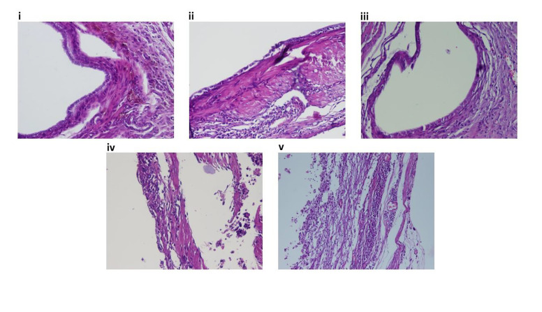 Potential Effects of Soy Isoflavones and Broccoli Extract on Oxidative Stress, Autophagy, and Apoptosis Gene Markers in Endometriosis.