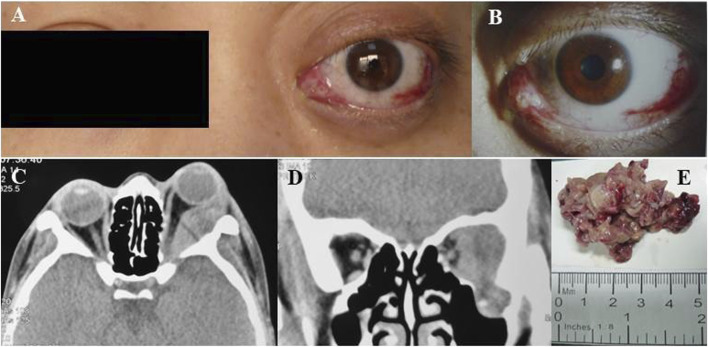Case report: Orbital myeloid sarcoma: a report of two rare cases and review of the literature.