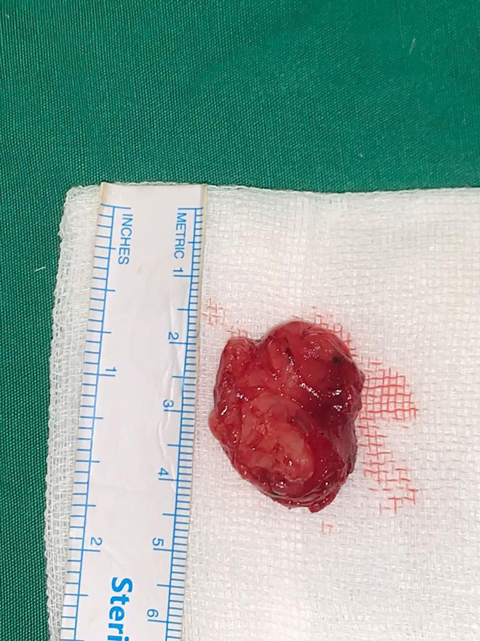 Wide-Excision Choice in Orbital Rhabdomyosarcoma on an 8-Year-Old Patient in a Low-Resource Setting: A Case Report.