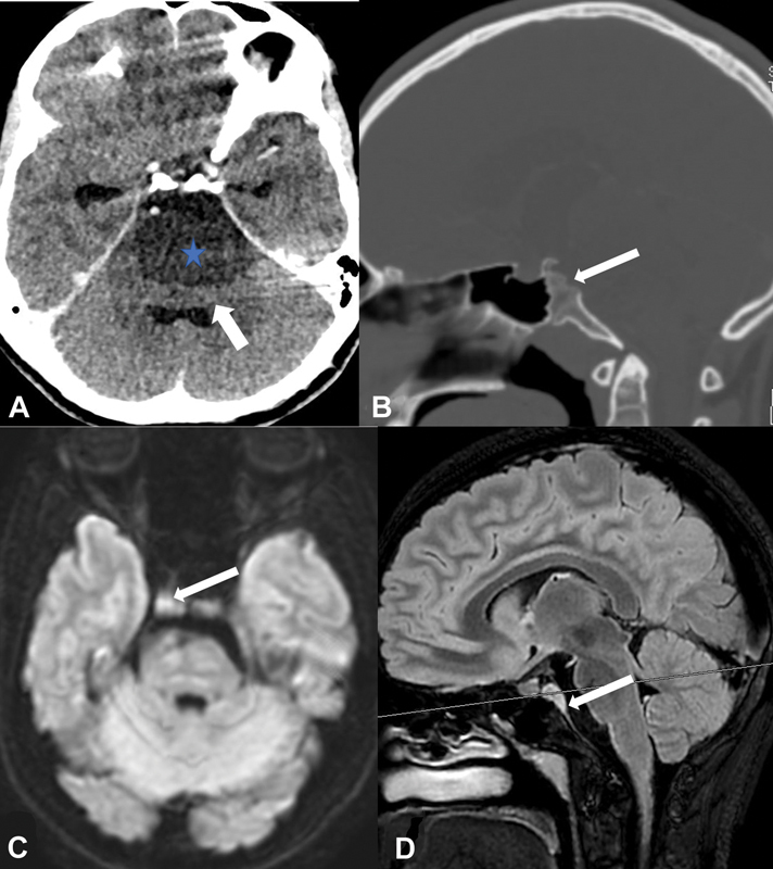 Nonenhancing Prepontine Chordoma with Diffusion Restriction Mimicking an Epidermoid Cyst.