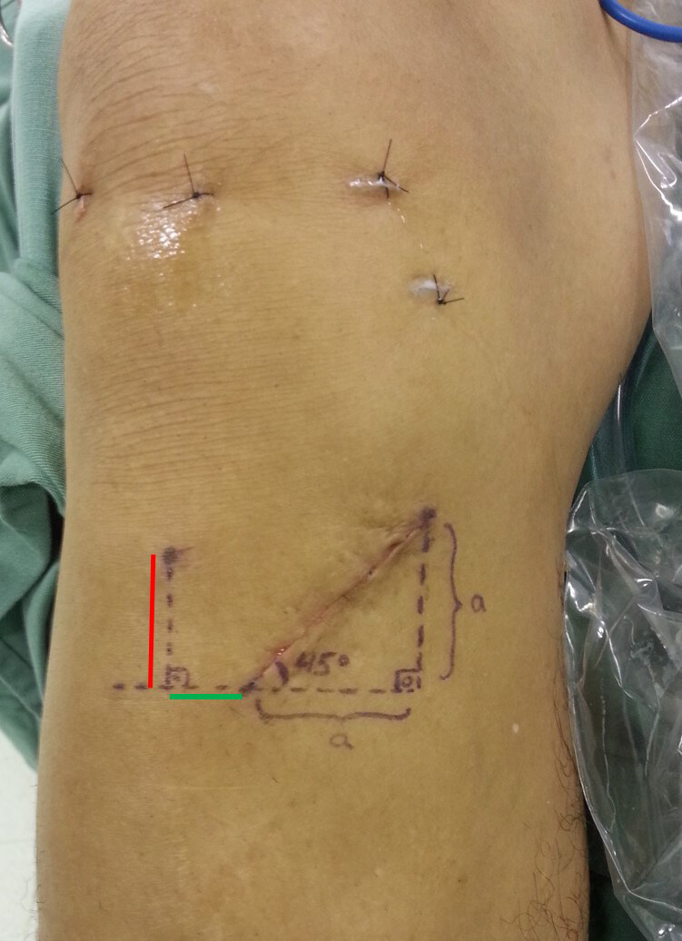 CAN SENSORY DISTURBANCES DUE TO INJURY TO THE INFRAPATELLAR BRANCH OF THE SAPHENOUS NERVE BE PREVENTED BY AN OBLIQUE INCISION?